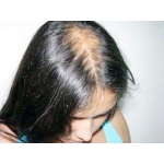 Лечение (без гормонов)  алопеции и выпадения волос,  лечение облысения