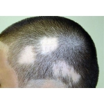 Лечение выпадения волос,  лечение всех форм облысения - без гормонов